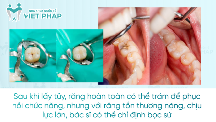 [Giải đáp từ chuyên gia] Lấy tủy răng xong trám răng được không?