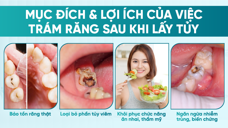 Lay tuy rang xong tram rang duoc khong 2 Mục đích & Lợi ích của việc trám răng sau khi lấy tủy