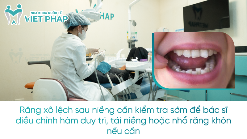 Răng xô lệch sau niềng cần kiểm tra sớm để bác sĩ điều chỉnh hàm duy trì, tái niềng hoặc nhổ răng khôn nếu cần