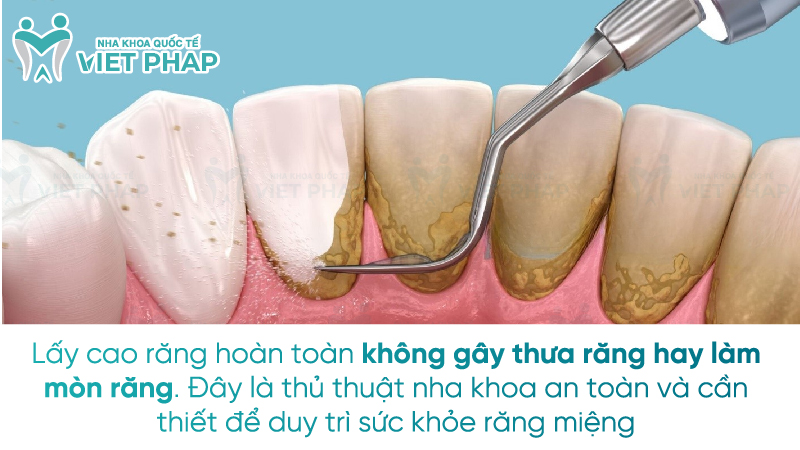 Lấy cao răng hoàn toàn không gây thưa răng hay làm mòn răng. Đây là thủ thuật nha khoa an toàn và cần thiết để duy trì sức khỏe răng miệng