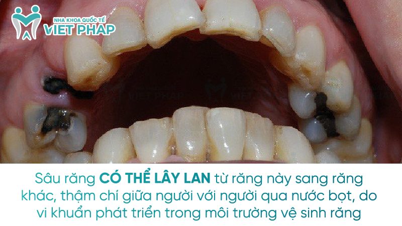 Sau rang co lay khong 1 Sâu răng CÓ THỂ LÂY LAN từ răng này sang răng khác, thậm chí giữa người với người qua nước bọt, do vi khuẩn phát triển trong môi trường vệ sinh răng miệng kém