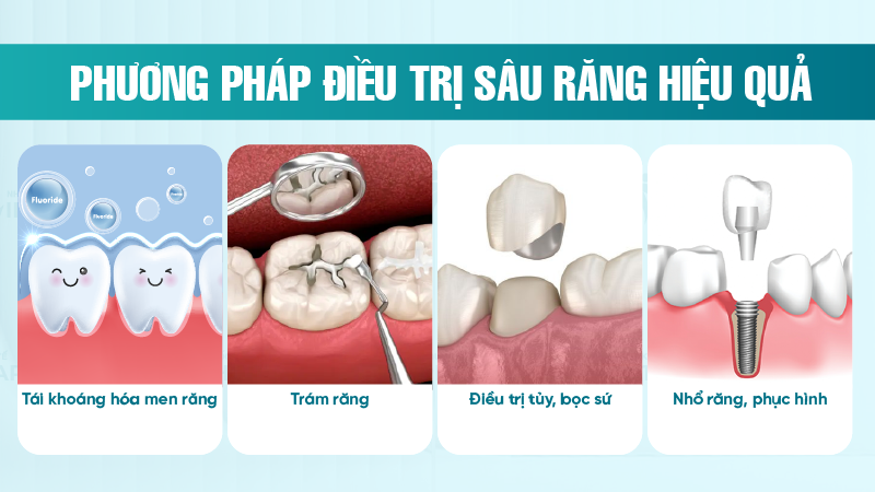 Sau rang co lay khong 5 Biện pháp ngăn ngừa sâu răng lây lan hiệu quả