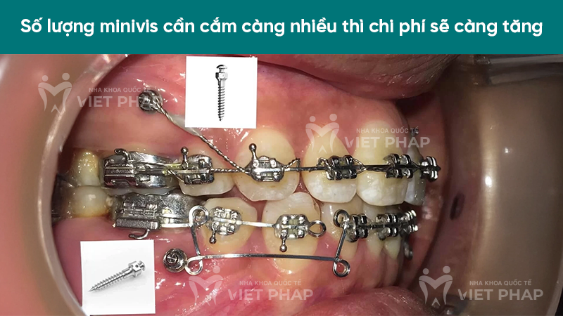 Số lượng minivis cần cắm càng nhiều thì chi phí sẽ càng tăng