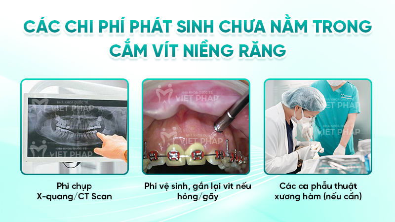 Các chi phí phát sinh chưa nằm trong cắm vít niềng răng