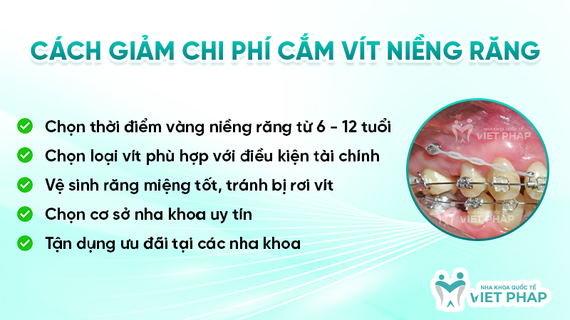Cách giảm chi phí cắm vít niềng răng