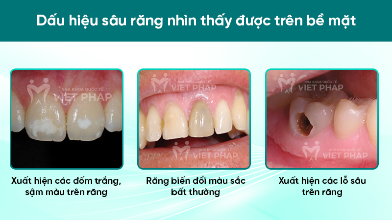 dau hieu sau rang 1 Dấu hiệu sâu răng nhìn thấy được trên bề mặt