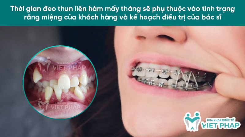 deo thun lien ham may thang 1 Thời gian đeo thun liên hàm mấy tháng sẽ phụ thuộc vào tình trạng răng miệng của khách hàng và kế hoạch điều trị của bác sĩ