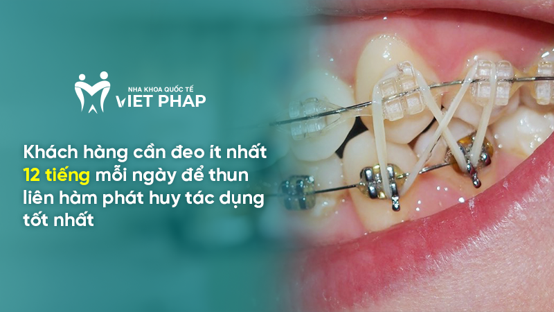 deo thun lien ham may thang 2.3 Khách hàng cần đeo ít nhất 12 tiếng mỗi ngày để thun liên hàm phát huy tác dụng tốt nhất