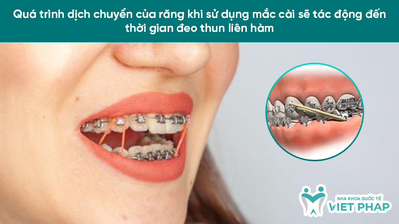 deo thun lien ham may thang 3.2 Quá trình dịch chuyển của răng khi sử dụng mắc cài sẽ tác động đến thời gian đeo thun liên hàm