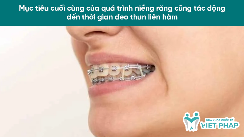 deo thun lien ham may thang 3.5 Mục tiêu cuối cùng của quá trình niềng răng cũng tác động đến thời gian đeo thun liên hàm
