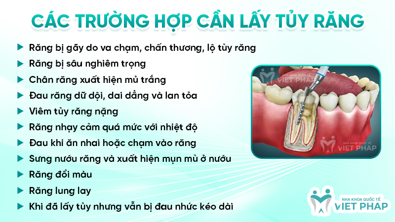 lay tuy rang co anh huong gi khong 3 Các trường hợp cần lấy tủy răng