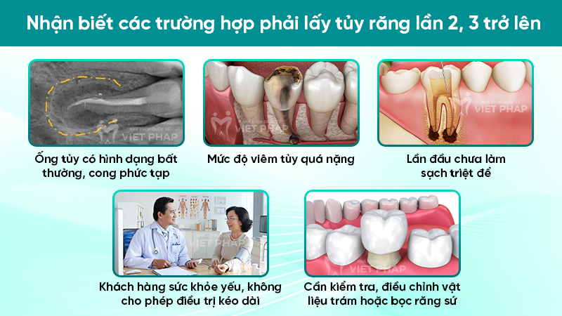 Nhận biết các trường hợp phải lấy tủy răng lần 2, 3 trở lên