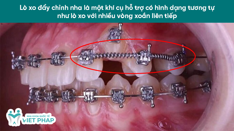 Lò xo đẩy chỉnh nha là một khí cụ hỗ trợ có hình dạng tương tự như lò xo với nhiều vòng xoắn liên tiếp