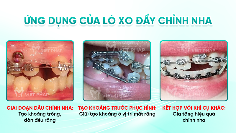 Ứng dụng của lò xo đẩy chỉnh nha 