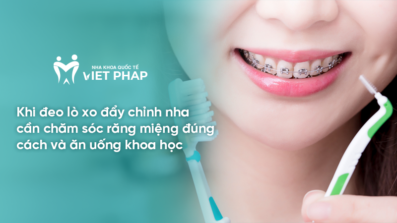 Khi đeo lò xo đẩy chỉnh nha cần chăm sóc răng miệng đúng cách và ăn uống khoa học
