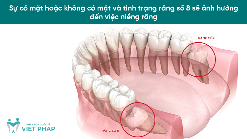 mat rang so 6 va 7 co nieng duoc khong 2.1 Sự có mặt hoặc không có mặt và tình trạng răng số 8 sẽ ảnh hưởng đến việc niềng răng