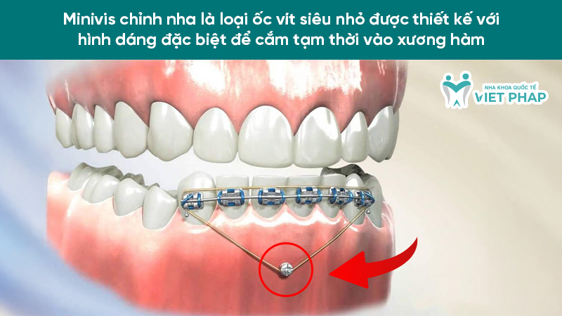 Minivis chỉnh nha là loại ốc vít siêu nhỏ được thiết kế với hình dáng đặc biệt để cắm tạm thời vào xương hàm