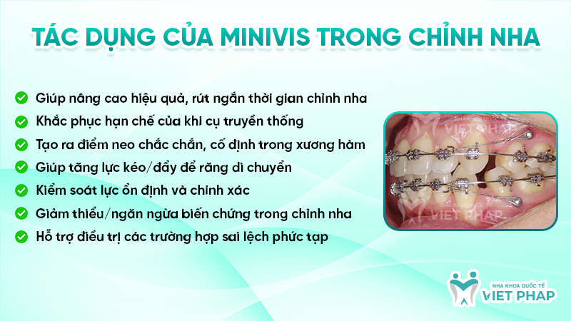 Tác dụng của Minivis trong chỉnh nha