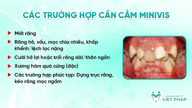 Các trường hợp cần cắm Minivis