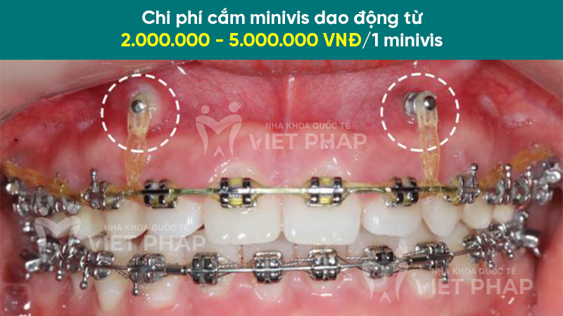 Chi phí cắm minivis dao động từ 2.000.000 - 5.000.000 VNĐ/1 minivis