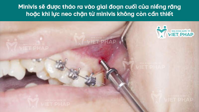 Minivis sẽ được tháo ra vào giai đoạn cuối của niềng răng hoặc khi lực neo chặn từ minivis không còn cần thiết