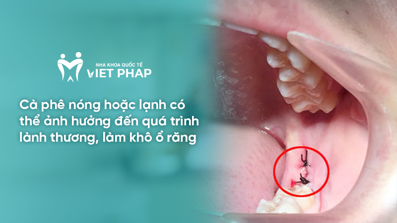 Cà phê nóng hoặc lạnh có thể ảnh hưởng đến quá trình lành thương, làm khô ổ răng