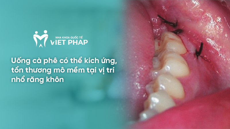 Uống cà phê có thể kích ứng, tổn thương mô mềm tại vị trí nhổ răng khôn