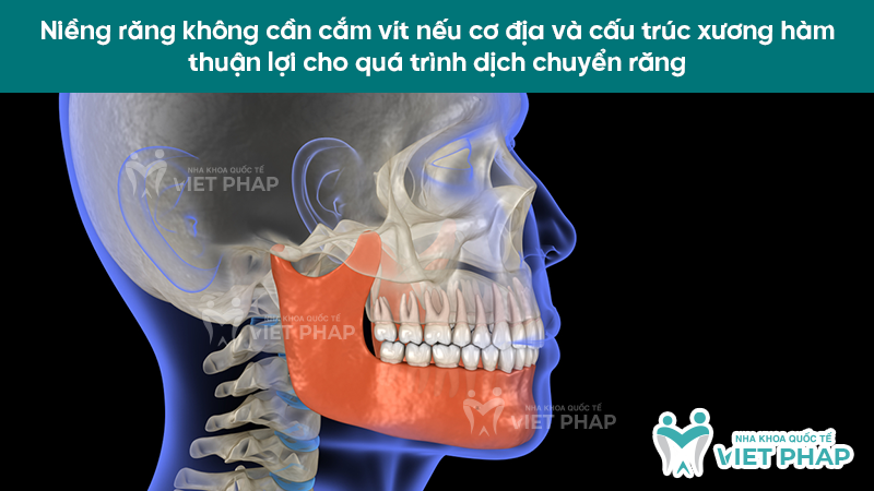 Niềng răng không cần cắm vít nếu cơ địa và cấu trúc xương hàm thuận lợi cho quá trình dịch chuyển răng