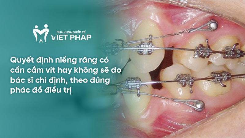 Quyết định niềng răng có cần cắm vít hay không sẽ do bác sĩ chỉ định, theo đúng phác đồ điều trị
