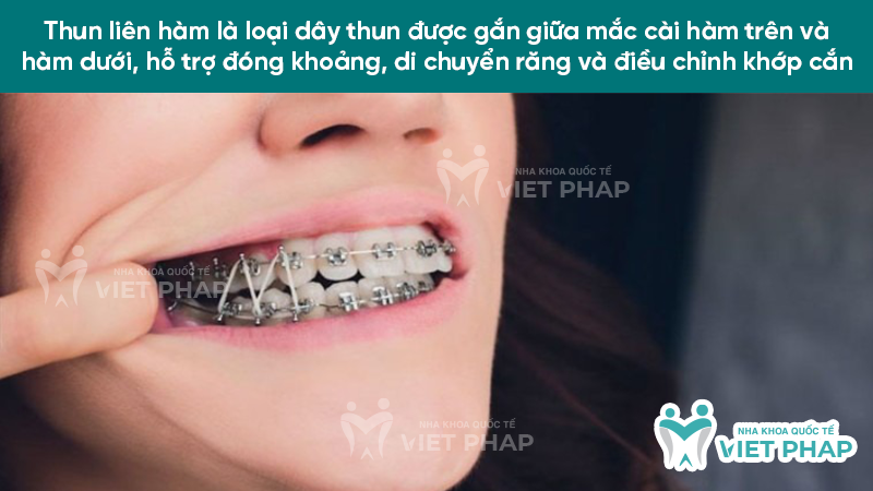 thun lien ham 1 Thun liên hàm là loại dây thun được gắn giữa mắc cài hàm trên và hàm dưới, hỗ trợ đóng khoảng, di chuyển răng và điều chỉnh khớp cắn