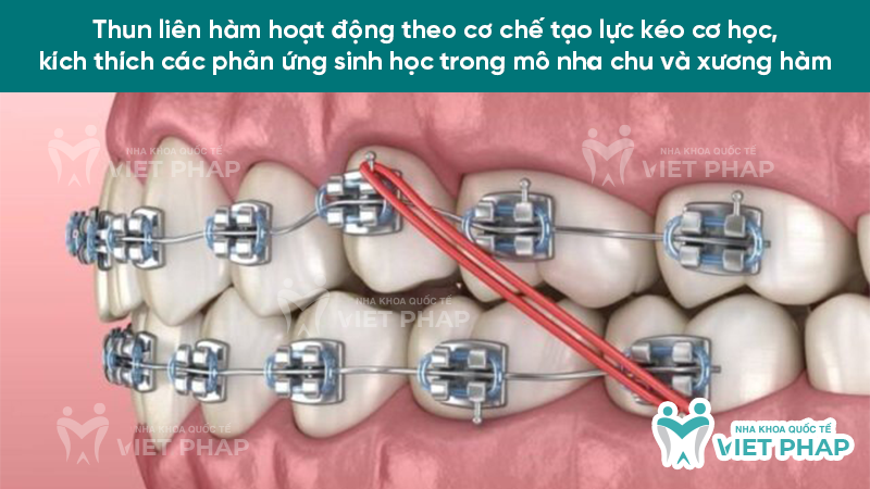 thun lien ham 2 Thun liên hàm hoạt động theo cơ chế tạo lực kéo cơ học, kích thích các phản ứng sinh học trong mô nha chu và xương hàm