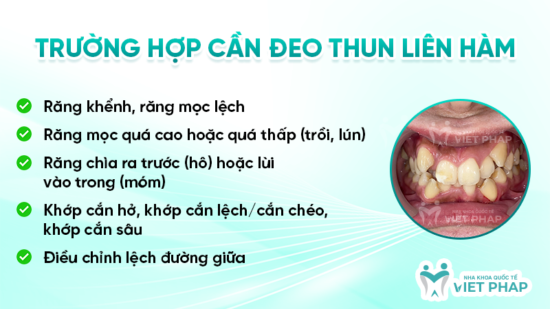 thun lien ham 4 Trường hợp cần đeo thun liên hàm