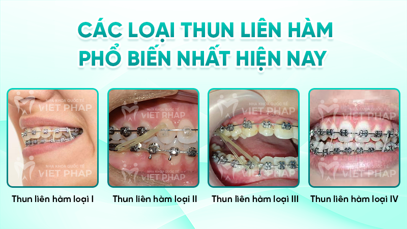thun lien ham 5 Các loại thun liên hàm phổ biến nhất hiện nay