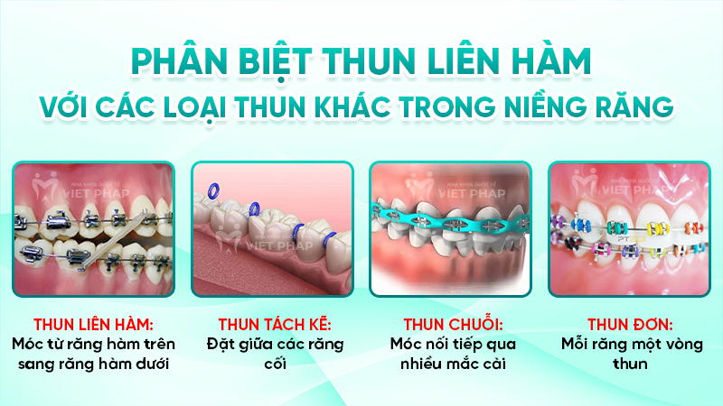 thun lien ham 6 Phân biệt thun liên hàm với các loại thun khác trong niềng răng
