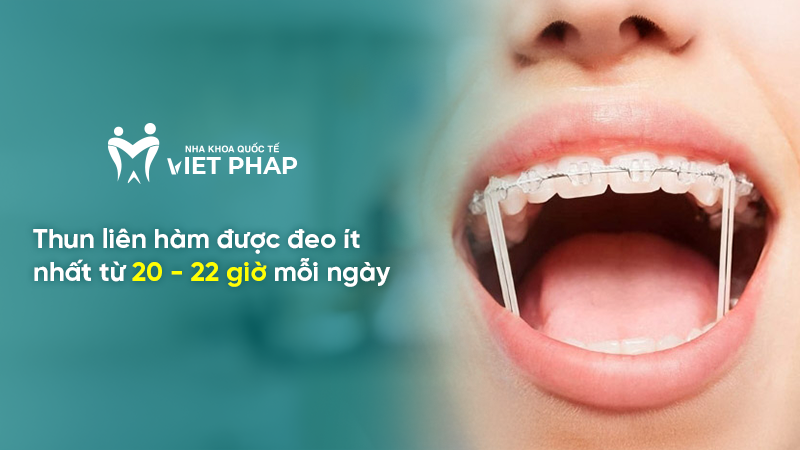 thun lien ham 7 Thun liên hàm được đeo ít nhất từ 20 - 22 giờ mỗi ngày