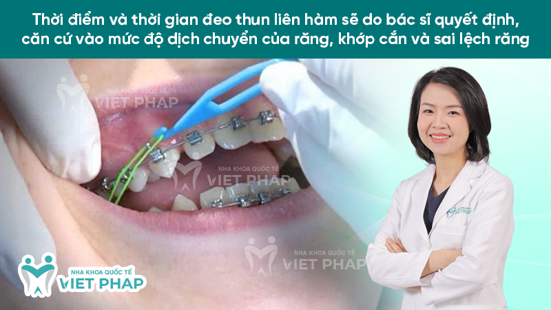thun lien ham 8 Thời điểm và thời gian đeo thun liên hàm sẽ do bác sĩ quyết định, căn cứ vào mức độ dịch chuyển của răng, khớp cắn và sai lệch răng