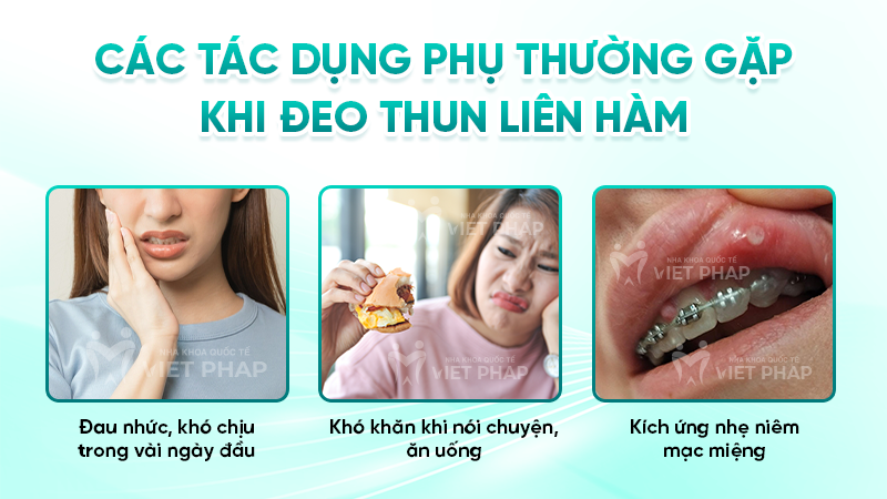 thun lien ham 9 Các tác dụng phụ thường gặp khi đeo thun liên hàm