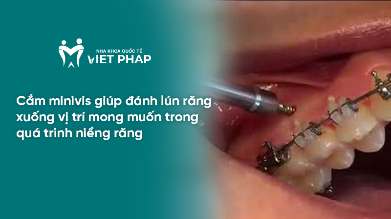 truong hop nao can cam minivis 9 Cắm minivis giúp đánh lún răng xuống vị trí mong muốn trong quá trình niềng răng