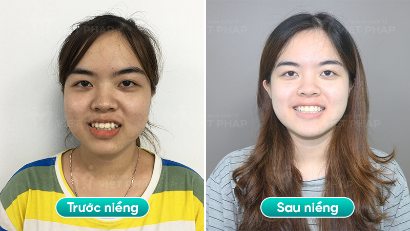3 bui kim chi Góc chính diện của bạn Bùi Kim Chi, trước và sau khi niềng răng hô, vẩu
