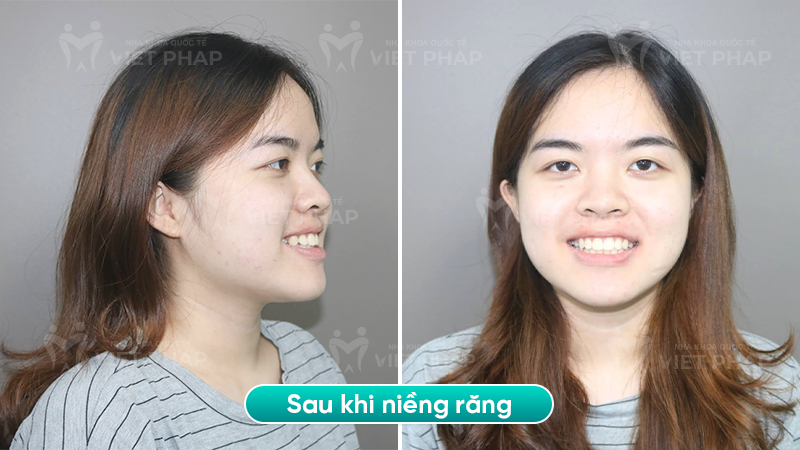 4 bui kim chi sau Hình ảnh sau khi niềng răng vẩu của chị Bùi Kim Chi