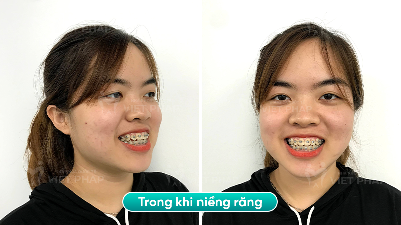 4 bui kim chi trong Hình ảnh chị Bùi Kim Chi trong quá trình niềng răng