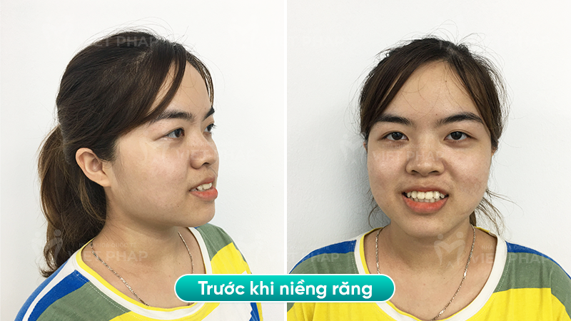 4 bui kim chi truoc Hình ảnh chị Bùi Kim Chi trước khi niềng răng