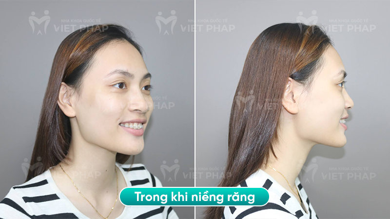 4 nguyen thi chi trong Hình ảnh chị Nguyễn Thị Chi trong quá trình niềng răng vẩu