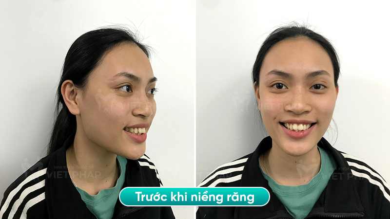 4 nguyen thi chi truoc Hình ảnh trước khi niềng răng của chị Nguyễn Thị Chi