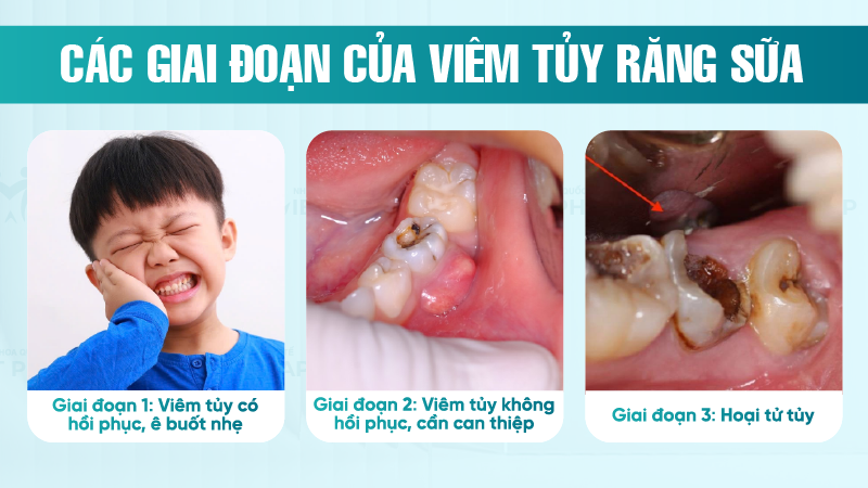 Dieu tri tuy rang sua 1 Các giai đoạn của viêm tủy răng sữa