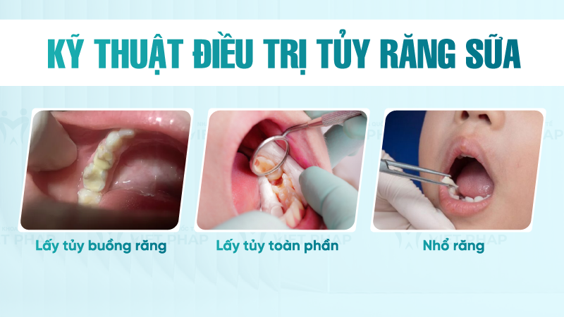 Dieu tri tuy rang sua 3 Kỹ thuật điều trị tủy răng sữa