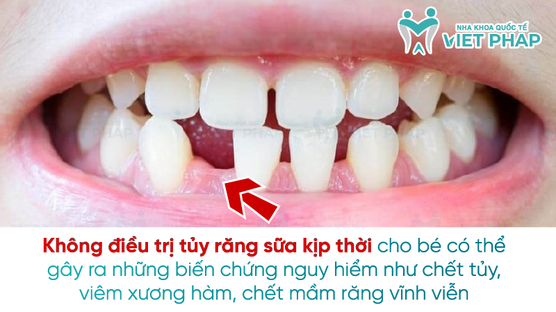 Dieu tri tuy rang sua 6 Không điều trị tủy răng sữa kịp thời cho bé có thể gây ra những biến chứng nguy hiểm như chết tủy, viêm xương hàm, chết mầm răng vĩnh viễn