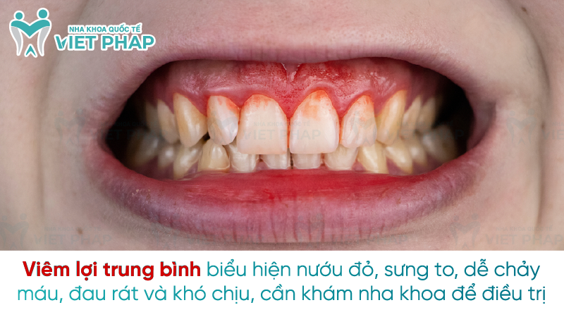 Viêm lợi trung bình biểu hiện nướu đỏ, sưng to, dễ chảy máu, đau rát và khó chịu, cần khám nha khoa để điều trị