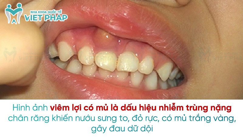 Hình ảnh viêm lợi có mủ là dấu hiệu nhiễm trùng nặng chân răng khiến nướu sưng to, đỏ rực, có mủ trắng vàng, gây đau dữ dội