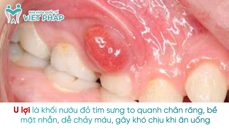 U lợi là khối nướu đỏ tím sưng to quanh chân răng, bề mặt nhẵn, dễ chảy máu, gây khó chịu khi ăn uống